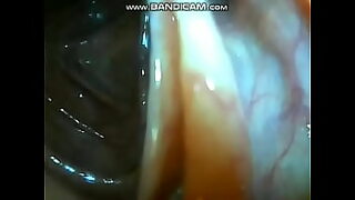 2 vaginal